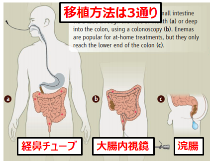 便移植のやり方：移植方法は3通り